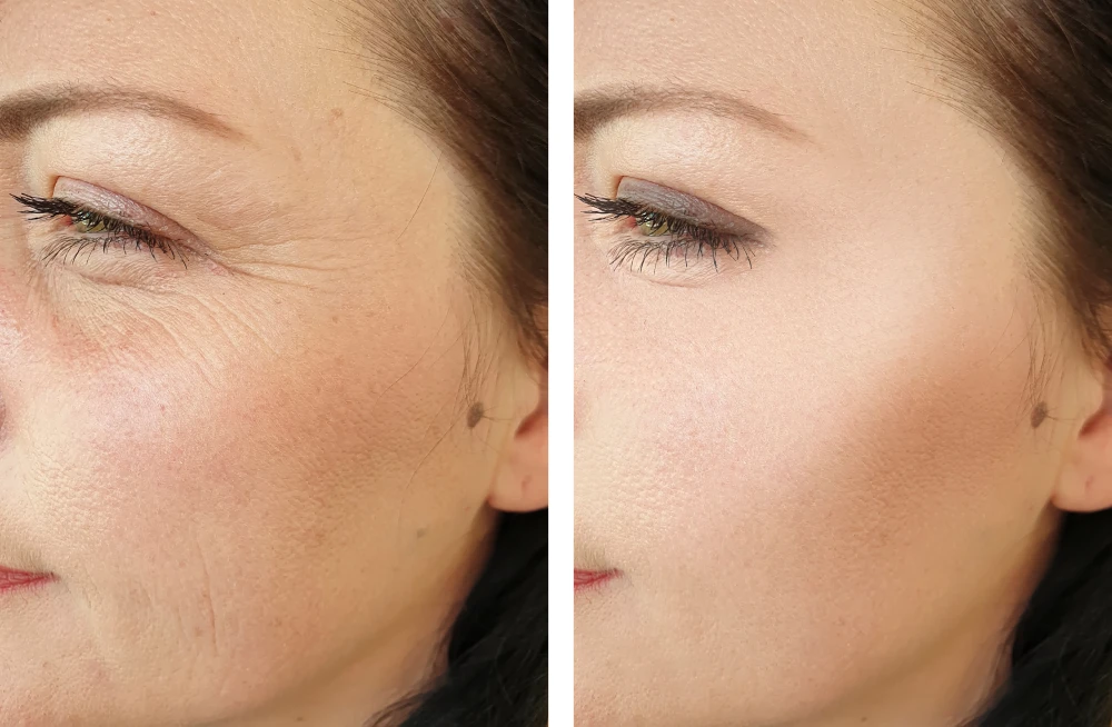 Before and after microneedling showing reduced wrinkles and smoother skin.