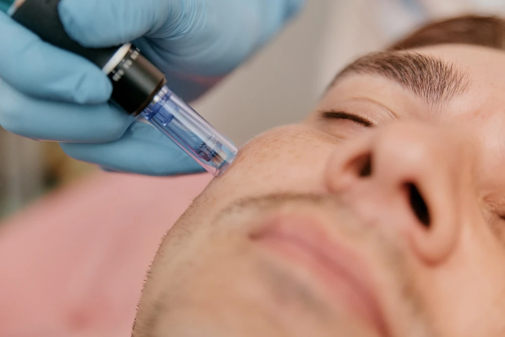 Man receiving professional microneedling facial treatment.