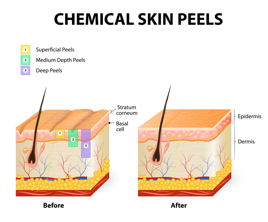 labeled diagram showing skin layers and peel depths with before and after sections
