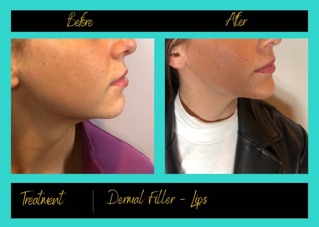 Patient treatment result at Prima Doll Aesthetics