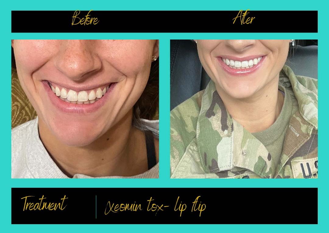 Patient treatment result at Prima Doll Aesthetics