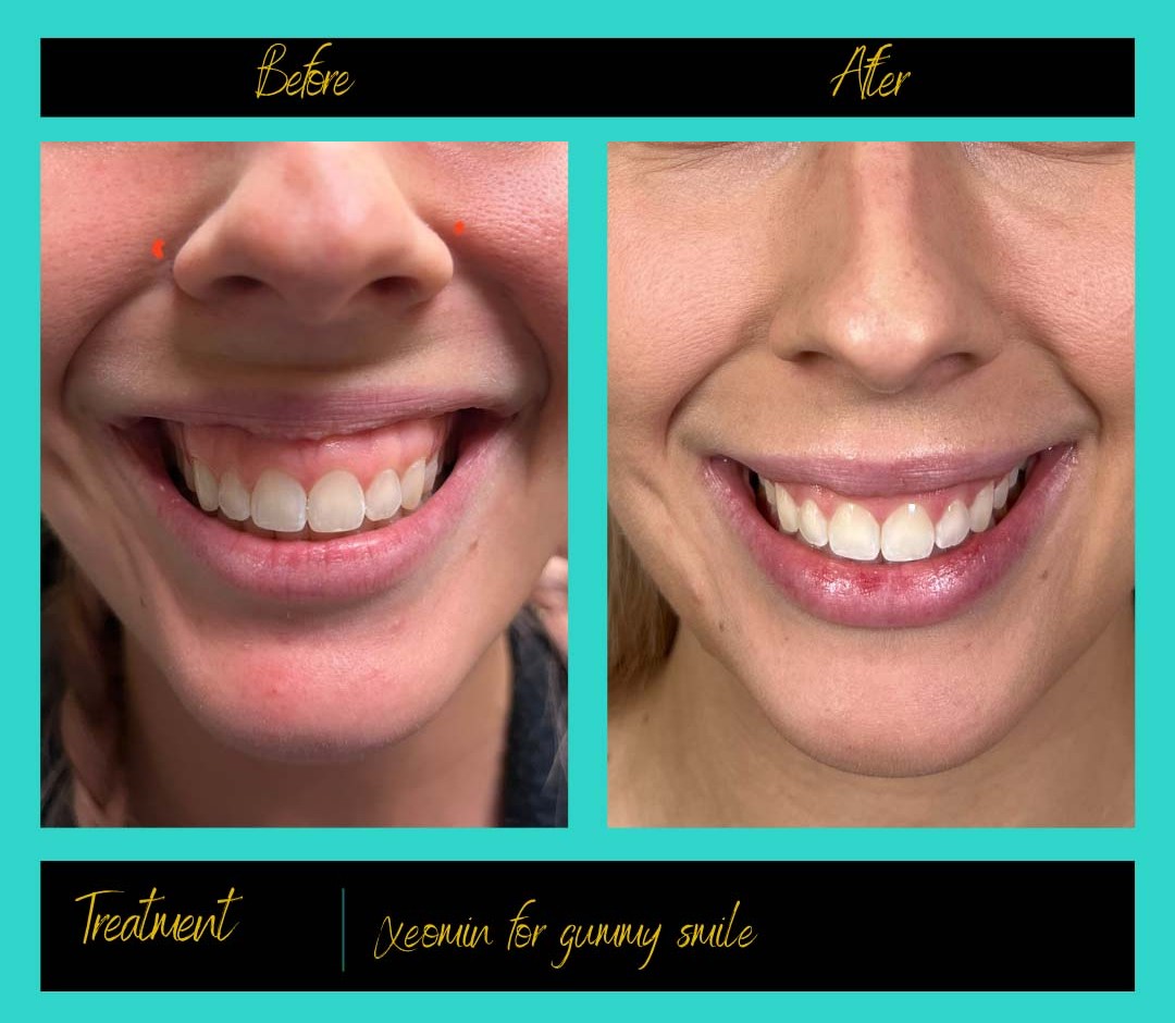 Patient treatment result at Prima Doll Aesthetics