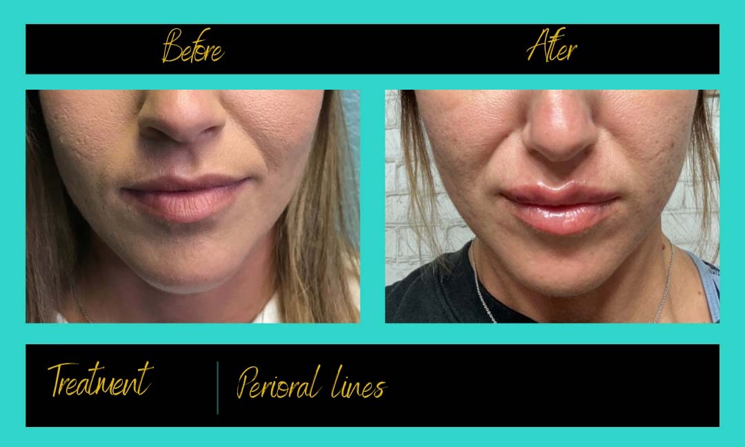 Patient treatment result at Prima Doll Aesthetics