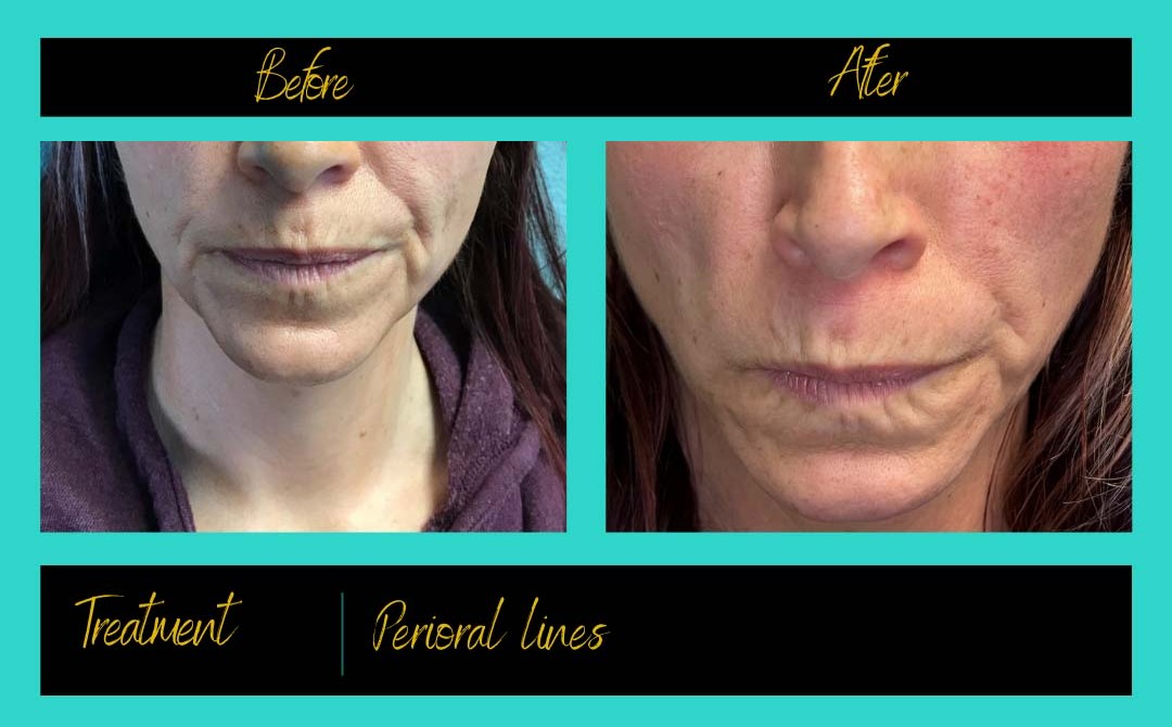 Patient treatment result at Prima Doll Aesthetics
