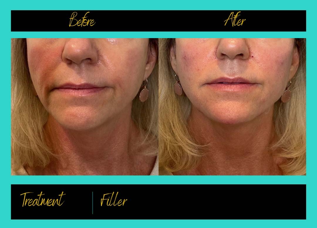 Patient treatment result at Prima Doll Aesthetics