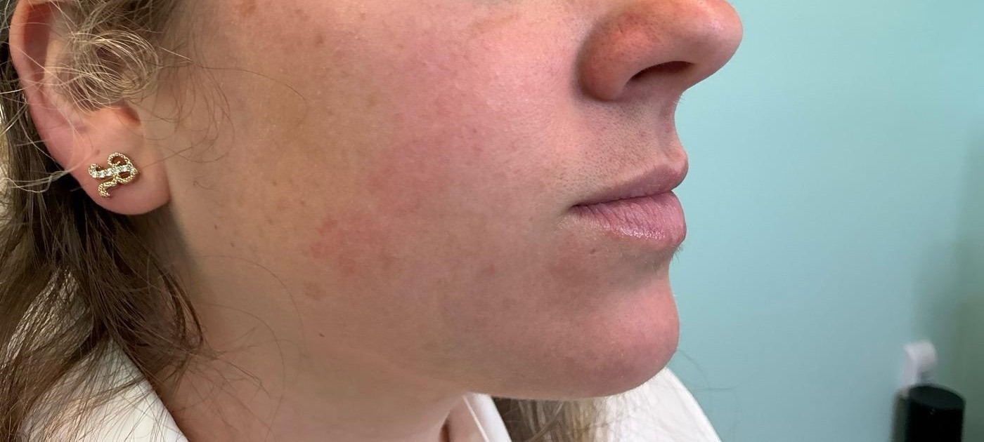 Patient treatment result at Prima Doll Aesthetics