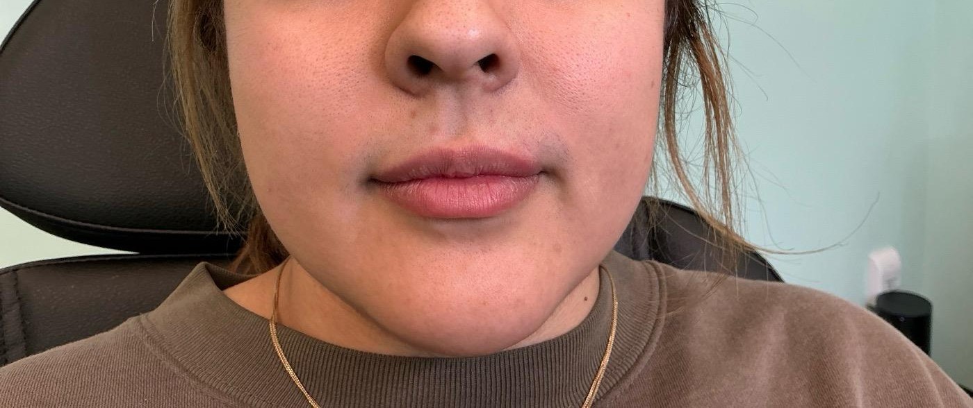 Patient treatment result at Prima Doll Aesthetics