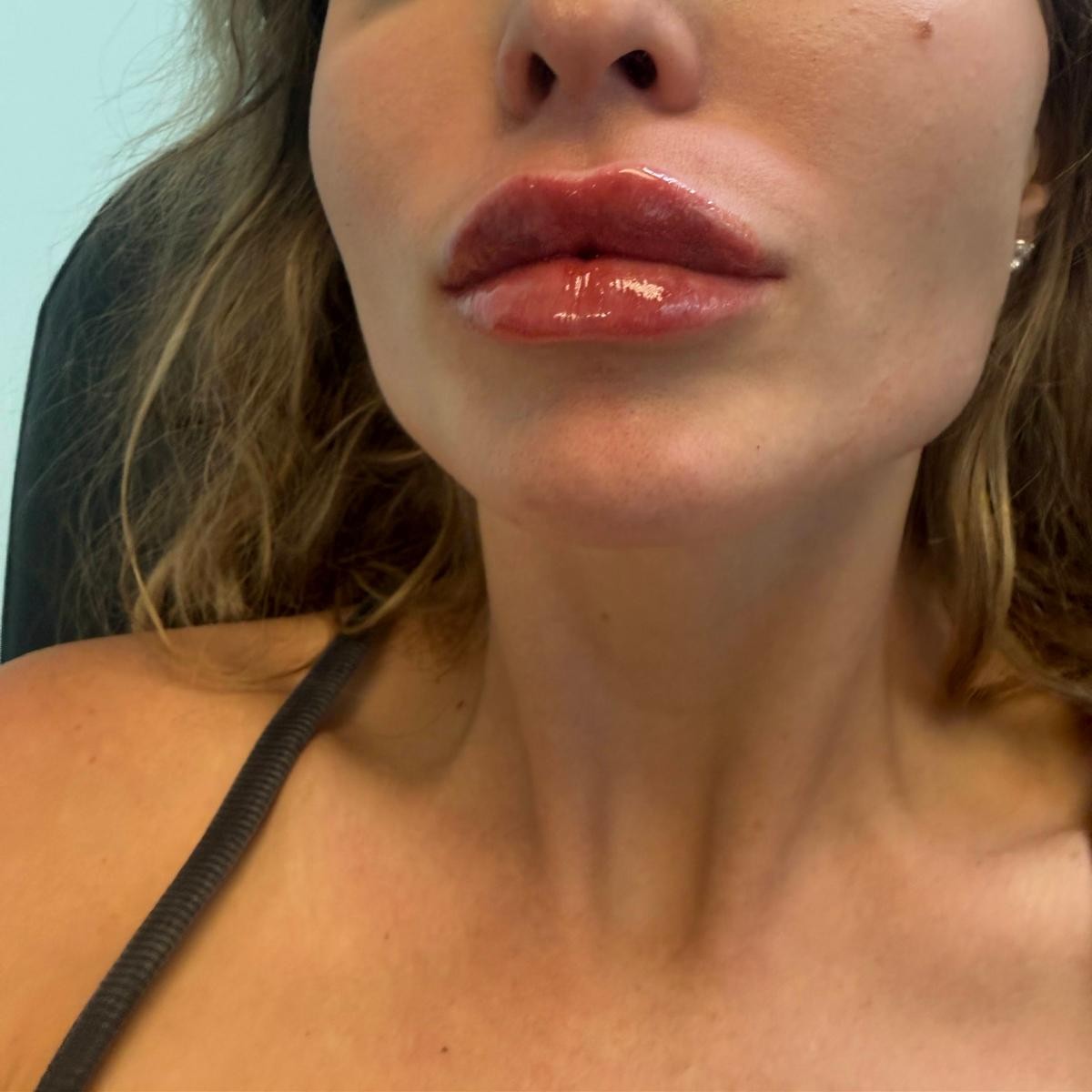Patient treatment result at Prima Doll Aesthetics